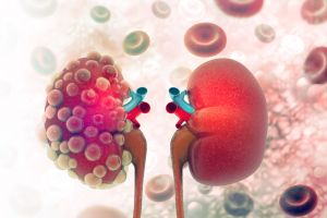 Graphical illustration of a pair of kidneys; the left being pockmarked with cysts